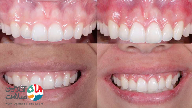 مراحل و مزایای جراحی افزایش طول تاج دندان 